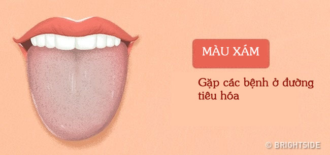 Tư vấn - Màu sắc lưỡi tiết lộ các vấn đề sức khỏe  (Hình 2).