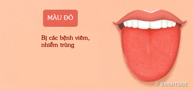 Tư vấn - Màu sắc lưỡi tiết lộ các vấn đề sức khỏe  (Hình 2).