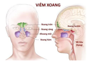 Những điều cần biết về bệnh Viêm Xoang mùa lạnh