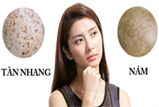 Phân biệt sự khác nhau giữa nám da và tàn nhang.