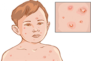 Phòng tránh bệnh thủy đậu