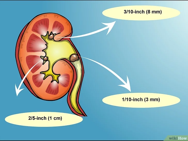 TiÃªu Äá» áº£nh Pass a Kidney Stone Step 1